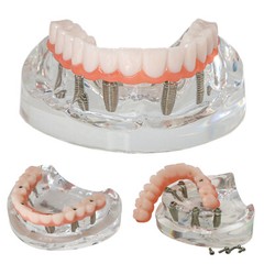 Dental All-On-6 Overdenture Implant Model Demo Upper Jaw 6 Screws Clear M6001-2