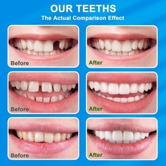 Veneers Teeth for Women, Tooth Replacement Missing Teeth, Upper Veneer 6PCS