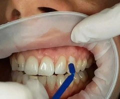 Denpro Cavity Varnish with Flouride 15gm For Dental Use (FREE & FAST SHIPPING).
