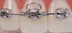 (10 pieces) Orthodontic TORQUING SPRING .019″ x .025″ SMALL / USA seller