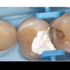 Dental White Teflon Matrix Bands Universal Contoured Matrices Wedges Filling Gap