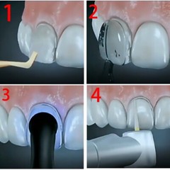Tooth Veneer Mold Composite Resin Veneer Aesthetic Mould Light Cure Anterior