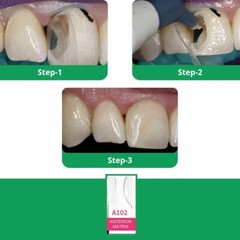 BioClear Anterior Kit Modern Matrix System for Esthetic Restorations Fast Ship