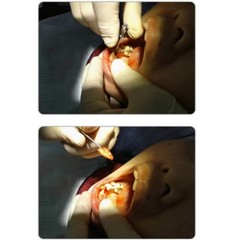 Dental Tooth Root Extractor