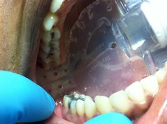 REDUCE DENTAL AEROSOLS; AUTOCLAVABLE 2 PEDO DRYSHIELD ISOLATION MOUTH PIECES