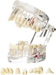 Educational Implant Typodont Model for Role Play – Perfect for Dental Schools
