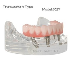 All-On-4 Dental Implant System Overdenture Treatment Teeth Model U/L Jaw W/screw