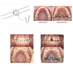 Dental MSE Maxillary Skeletal Expander Orthodontics Expansion Screw Split BMK