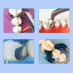 Dental Matrix Bands Ring Sectional Matrice Clamp Clear Anterior Matrix System