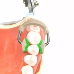 75Type Dental Matrix Bands Ring Sectional Matrice Clamp Fit Garrison Palodent V3