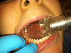 REDUCE DENTAL AEROSOLS; AUTOCLAVABLE 2 LARGE DRYSHIELD ISOLATION MOUTH PIECES