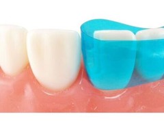 Dental Contoured Anterior Matrix Bands Polyester Anterior Strips Matrices System