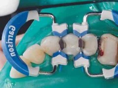 Garrison Dental Composi-Tight 3D Fusion Matrix Rings,Free Shipping