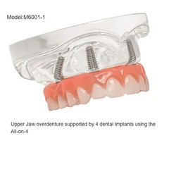 All-On-4 Dental Implant System Overdenture Treatment Teeth Model U/L Jaw W/screw