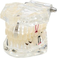 Educational Implant Typodont Model for Role Play – Perfect for Dental Schools