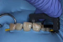 Easyinsmile IPR Orthodontics Stripping Dental Kit Interproximal Reduction Strips