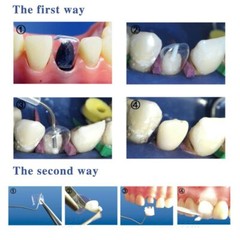 Anterior Transparent Crowns Dental Temporary Crown Adult Braces Pre-crowned