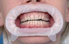 `10 x Ivoclar OPTRAGATE 3D Mouth Opener Cheek & Lip Retractor Small/Regular