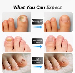 Nail Fungus Laser Nail Fungus Cleaning LED Light Device For Multiple Toenail