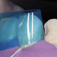 Dental Contoured Anterior Matrix Bands Polyester Anterior Strips Matrices System