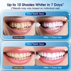 Teeth Whitening Kit with LED Light – 3 0.68 Fl Oz (Pack of 1), White