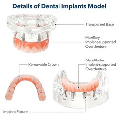 US Dental Overdenture All-on-4/6 Upper/Lower Jaw Teeth Model with 4/6 Screws
