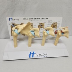Degenerative Joint Disease 4 Stage Osteoarthritis Osteoarthritic Shoulder Model