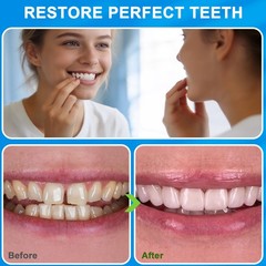 Veneers Teeth for Women, Tooth Replacement Missing Teeth, Upper Veneer 6PCS