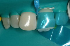 Dental Blue View Strip Anterior Restoration Strips Composite BT Clear Matrix