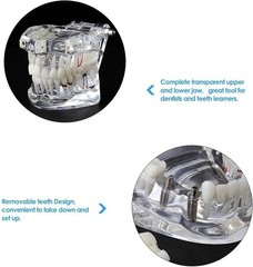 Educational Implant Typodont Model for Role Play – Perfect for Dental Schools