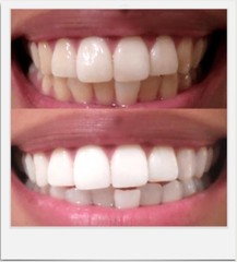 Expertwhite Teeth Whitening Gel Refills (6-gels). Made 0.1 Fl Oz (Pack of 6)