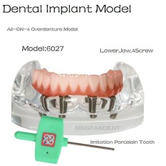 All-On-4 Dental Implant System Overdenture Treatment Teeth Model U/L Jaw W/screw