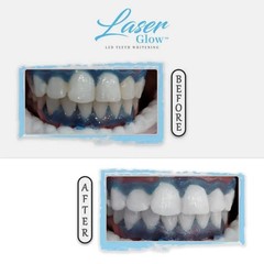 LaserGlow Professional Teeth Whitening Gel 44% Hydrogen 1 Fl Oz (Pack of 1)