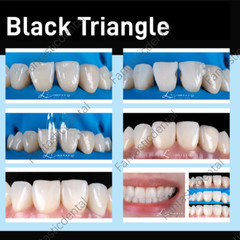 Dental Transparent Matrix Clear Bow Matrice Band Anterior Front Bioclear TorVM