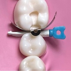 Dental Matrix Bands Ring Sectional Matrix System Clamp Plastic Tulwar Wedges Set