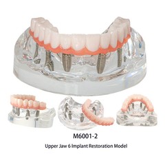 US Dental Overdenture All-on-4/6 Upper/Lower Jaw Teeth Model with 4/6 Screws