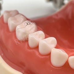 Dental Matrix Bands Ring Sectional Matrice Clamp Clear Anterior Matrix System