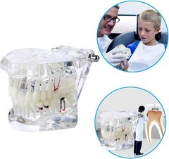 Educational Implant Typodont Model for Role Play – Perfect for Dental Schools