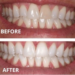 Expertwhite Teeth Whitening Gel Refills (6-gels). Made 0.1 Fl Oz (Pack of 6)