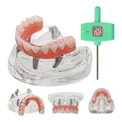 All-On-4 Dental Implant System Overdenture Treatment Teeth Model U/L Jaw W/screw